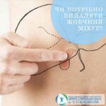 Коли потрібно видаляти жовчний міхур?