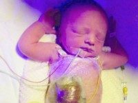 Забрали на кесарів розтин, а в дитини на животі дірка