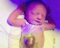 Забрали на кесарів розтин, а в дитини на животі дірка