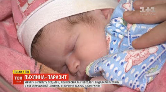 В Інституті педіатрії, акушерства та гінекології ім. О.М. Лук’янової НАМН України лікарі видалили пухлину, що важила майже половину новонародженої дитини