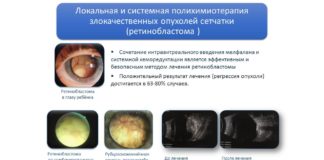 Способи діагностики та лікування доброякісних та злоякісних новоутворень кон’юнктиви у дітей