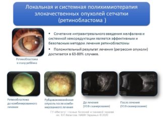 Способи діагностики та лікування доброякісних та злоякісних новоутворень кон’юнктиви у дітей