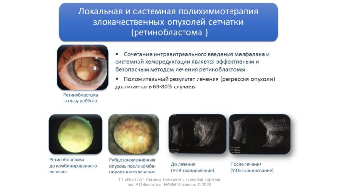 Способи діагностики та лікування доброякісних та злоякісних новоутворень кон’юнктиви у дітей