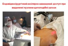 Впроваджено мінімально-інвазивну відеоасістуючу тіреоїдектомію з аксиллярно-маммарного доступу