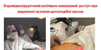 Впроваджено мінімально-інвазивну відеоасістуючу тіреоїдектомію з аксиллярно-маммарного доступу