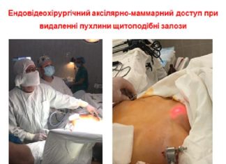 Впроваджено мінімально-інвазивну відеоасістуючу тіреоїдектомію з аксиллярно-маммарного доступу