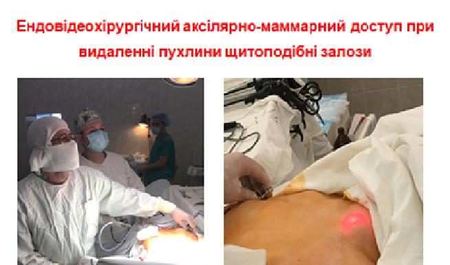 Впроваджено мінімально-інвазивну відеоасістуючу тіреоїдектомію з аксиллярно-маммарного доступу