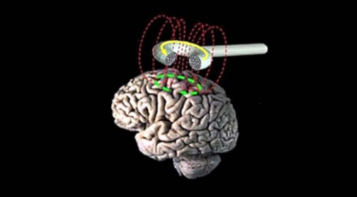 Ритмічна транскраніальна магнітна стимуляція