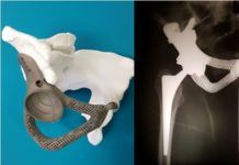 В ДУ «Інститут травматології та ортопедії НАМН України» розроблені нові технології лікування хворих із пухлинами та захворюваннями кісток