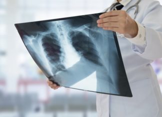 Україна стала першою країною, де запроваджено новий режим лікування стійкої форми туберкульозу