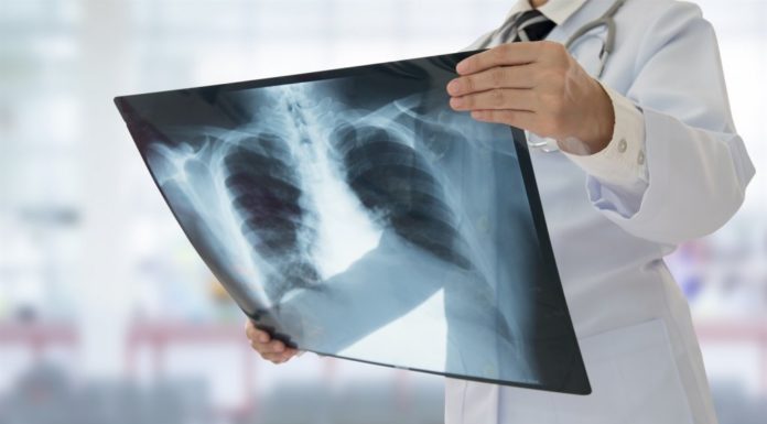 Україна стала першою країною, де запроваджено новий режим лікування стійкої форми туберкульозу