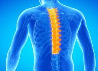 Правобічний ідіопатичний грудний сколіоз IV ступеня. Клінічний випадок