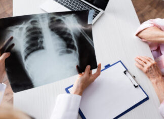 Легені при важкому перебігу Covid-19 – це суцільний згусток крові – академік Фещенко