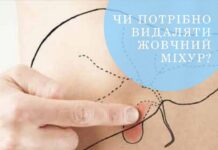 Коли потрібно видаляти жовчний міхур?