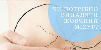 Коли потрібно видаляти жовчний міхур?