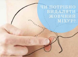 Коли потрібно видаляти жовчний міхур?