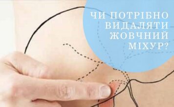 Коли потрібно видаляти жовчний міхур?