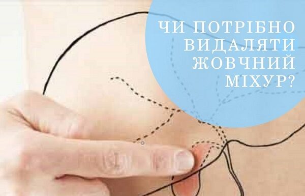 Коли потрібно видаляти жовчний міхур?