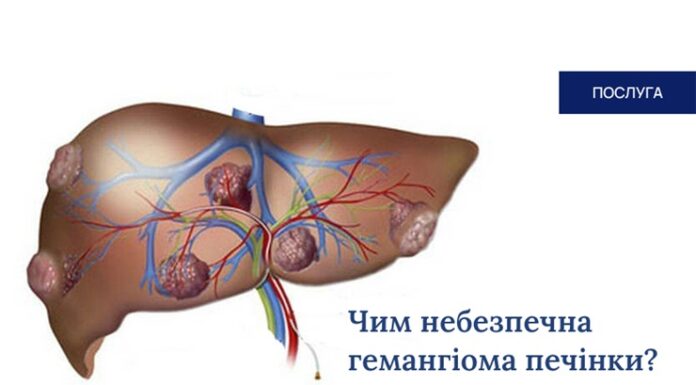 Чим небезпечна гемангіома печінки?