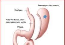 Рукавна резекція шлунка