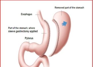 Рукавна резекція шлунка