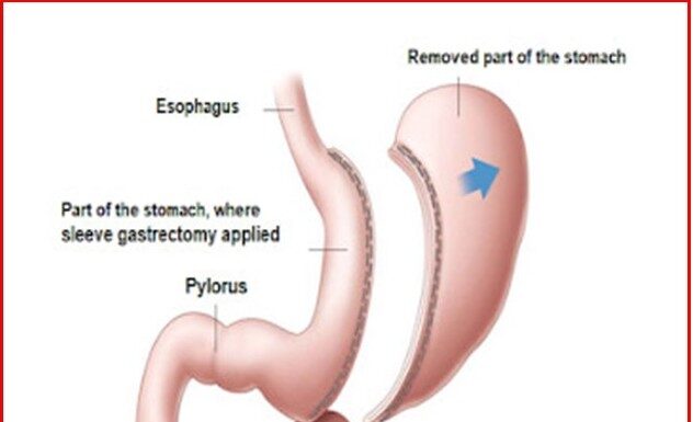 Рукавна резекція шлунка