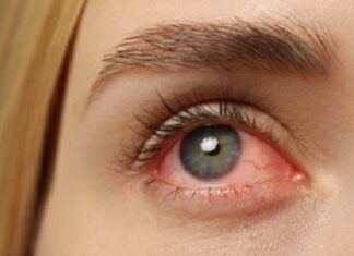 ЩО ТАКЕ СИНДРОМ «ЧЕРВОНОГО ОКА»?