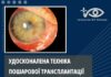УДОСКОНАЛЕНА ТЕХНІКА ПОШАРОВОЇ ТРАНСПЛАНТАЦІЇ АМНІОТИЧНОЇ МЕМБРАНИ