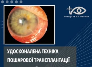 УДОСКОНАЛЕНА ТЕХНІКА ПОШАРОВОЇ ТРАНСПЛАНТАЦІЇ АМНІОТИЧНОЇ МЕМБРАНИ