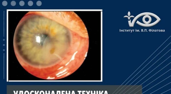 УДОСКОНАЛЕНА ТЕХНІКА ПОШАРОВОЇ ТРАНСПЛАНТАЦІЇ АМНІОТИЧНОЇ МЕМБРАНИ