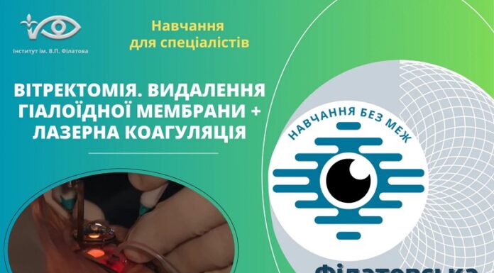 Запрошуємо вас на перегляд відео «Вітректомія. Видалення гіалоїдної мембрани + лазерна коагуляція»