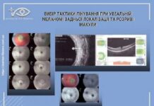 Вибір тактики лікування при увеальній меланомі задньої локалізації та розриві макули