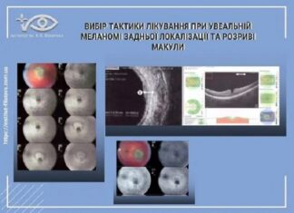 Вибір тактики лікування при увеальній меланомі задньої локалізації та розриві макули