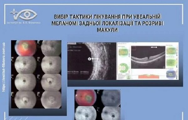 Вибір тактики лікування при увеальній меланомі задньої локалізації та розриві макули
