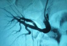 Випадок ендоваскулярного лікування стенозу ниркової артерії трансплантованої нирки в області судинного анастомозу