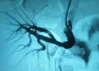 Випадок ендоваскулярного лікування стенозу ниркової артерії трансплантованої нирки в області судинного анастомозу