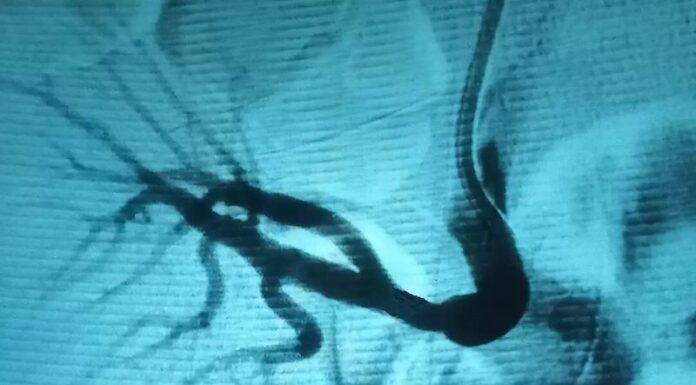 Випадок ендоваскулярного лікування стенозу ниркової артерії трансплантованої нирки в області судинного анастомозу