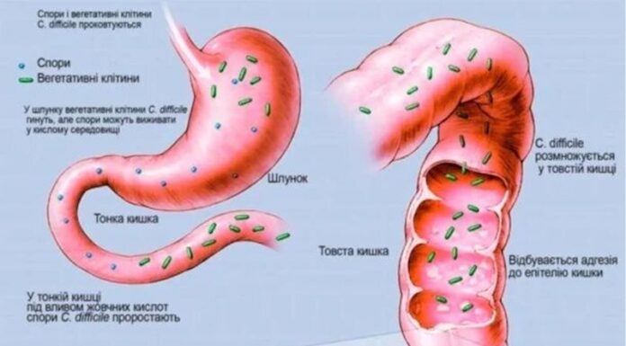 Методичні рекомендацій «Сучасні підходи до діагностики, лікування та профілактики антибіотико-асоційованої діареї»