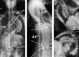 Виявлений сколіоз? Шукаєте найкращих спеціалістів для операції?