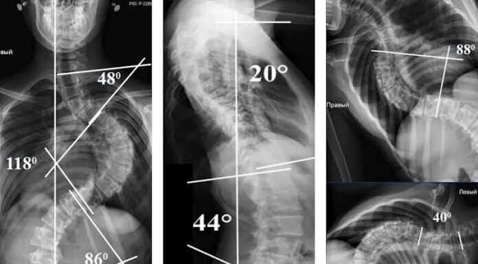 Виявлений сколіоз? Шукаєте найкращих спеціалістів для операції?