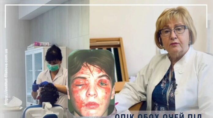 ОПІК ОБОХ ОЧЕЙ ПІД ЧАС ВИБУХУ ПЕТАРДИ В РУКАХ