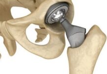 Фахова школа «Ендопротезування кульшового суглоба (особливості передопераційного планування та техніки виконання)»