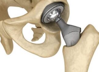 Фахова школа «Ендопротезування кульшового суглоба (особливості передопераційного планування та техніки виконання)»