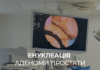 Енуклеація аденоми простати