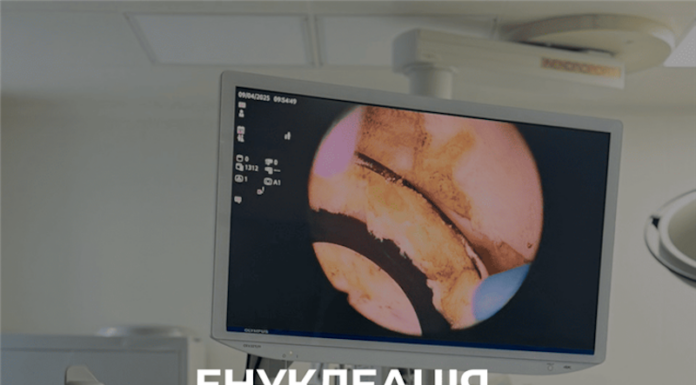 Енуклеація аденоми простати